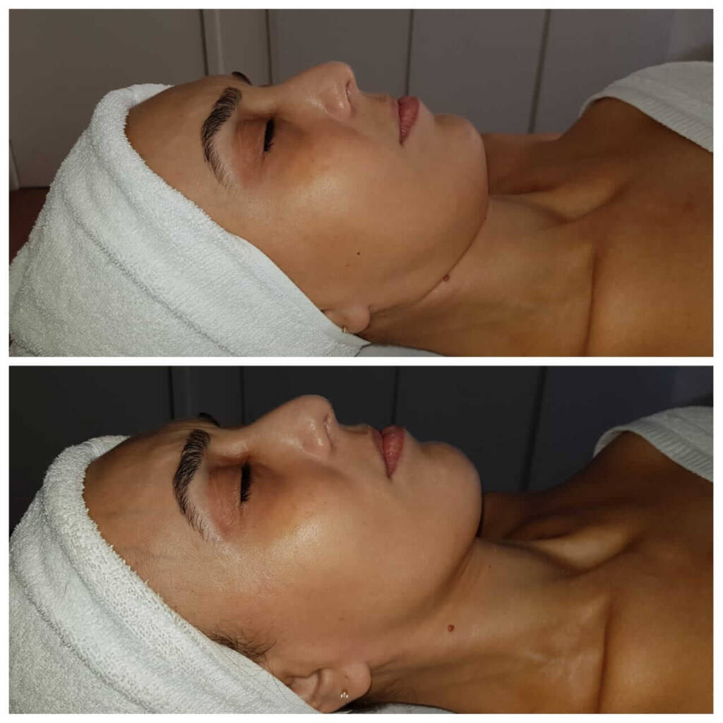 Drenagem Linfática Facial Miracle Face Método Renata França